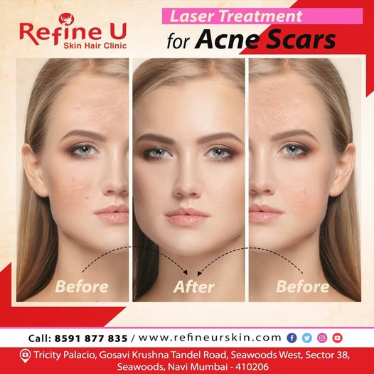 refine_u's tweet photo. Laser treatment for Acne Scars we do at Refine U Seawood Navi Mumbai India. 
. 
. 
 #acne #acnelasertreatment #lasertreatment #acneremoval #skincare #seawood #DrRashami #refineu #NaviMumbai https://t.co/mKgXqvJf7V