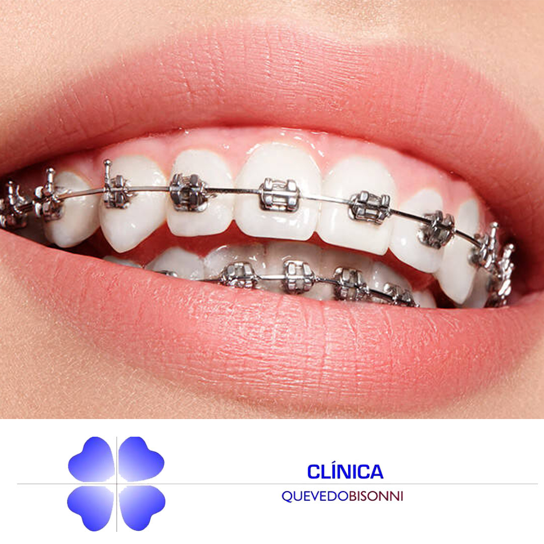 CQuevedoBisonni's tweet photo. ¡Buenos días Sonrisas!  ¿Los brackets son para todas las edades?
Muchas personas piensan que los brackets solo son para los niños y los adolescentes. En absoluto. Cualquier persona puede someterse a este tratamiento para corregir sus dientes.
.
#dientessanos #sonrisassanas https://t.co/1Oxql9k2VL