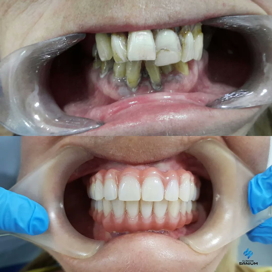 clinicassanium's tweet photo. Before &amp; After ✨

#implantologiadental #implantologia #implantes #odontologiadevanguardia #protesisfija #odontologia #saluddental #dentista #clinicassanium #sanium #albacete #hellin #villarrobledo https://t.co/QPmYSResok