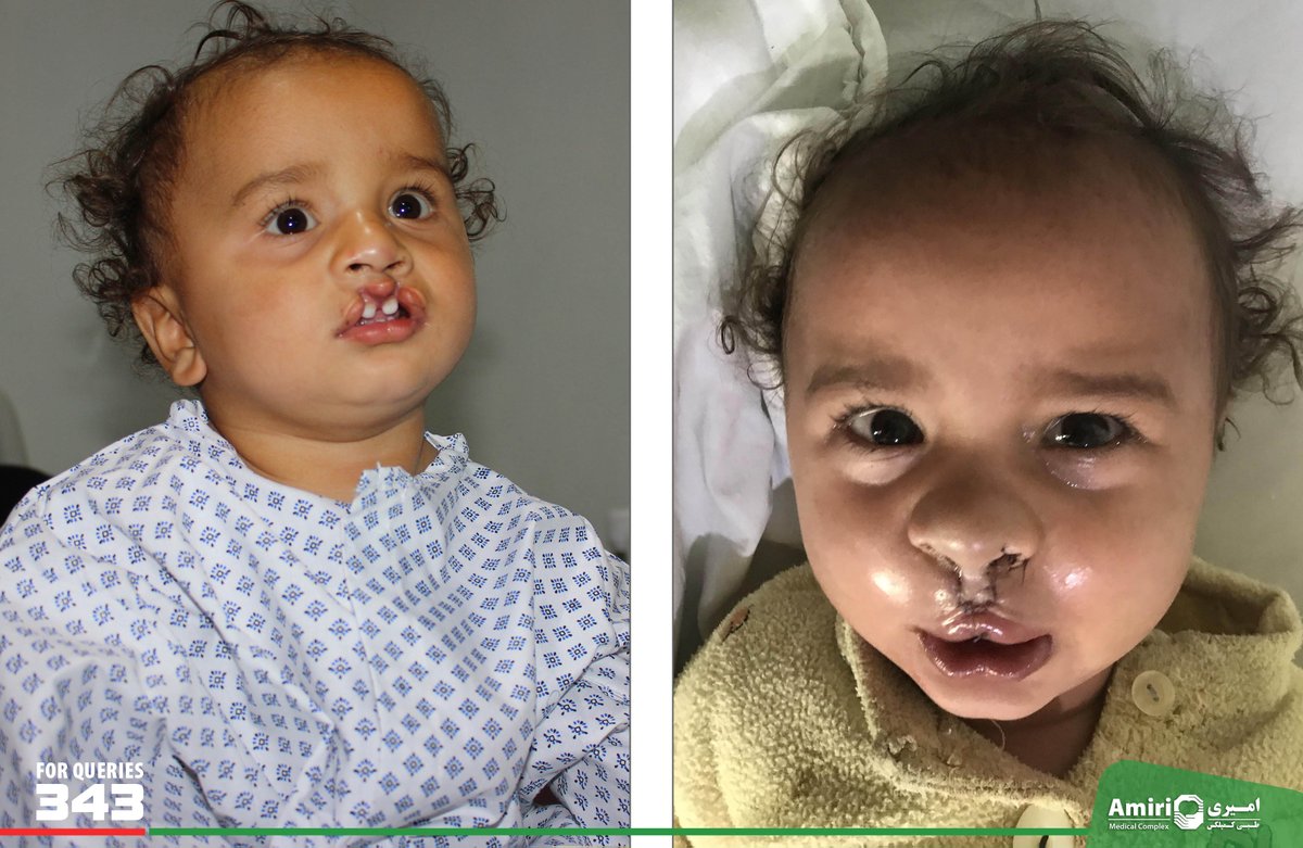 Cleft Palate & Cleft Lip Free Surgical Procedures Performed for Twenty Children. Dr. Mirwais Amiri CMD AMC and founder of AMA Welfare, speaking at event commended free surgical procedures performed by renowned plastic surgeon Dr. Abdul Ghafar under AMA Welfare at AMC.