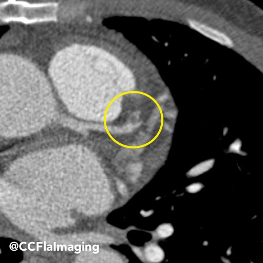CCFlaImaging's tweet photo. 46yo with acute chest pain. 
🔹LAD filling defect
🔹Short axis recon shows perfusion defect in LAD distribution

#radres #radiology #yesCCT @MedTwitter https://t.co/ahpc5XugGb