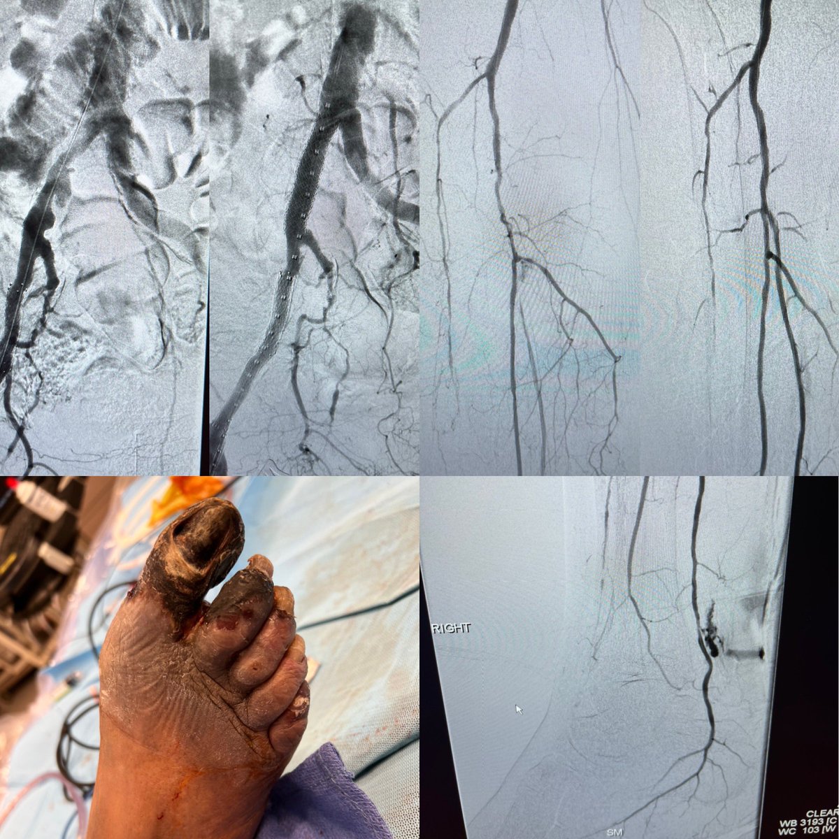limbsalvagedr's tweet photo. CIA 90% occluded on IVUS, CFA occluded, proximal PT occluded. CFA endart, CIA stented, retrograde pedal access and PTA PT #threelevels #palpablepulse #comprehensivevascularcare #hybridapproach @SammySiada https://t.co/c4PeiE5oIB