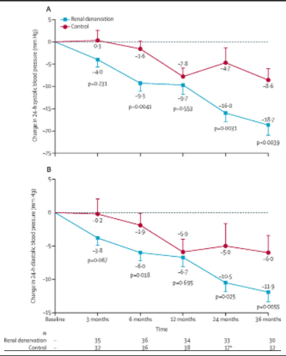 Jessamy Bagenal BSc, MBBS, MRCS, MPH, FRSPH 🖌🗣🌕 (@jessamybagenal) on Twitter photo Long term efficacy of renal denervation vs sham for #hypertension <a href="/FelixMahfoud/">Felix Mahfoud</a> + co <a href="/TheLancet/">The Lancet</a>
🌟👉clinically meaningful and lasting blood pressure reduction up to 36 mths follow-up
thelancet.com/journals/lance…
<a href="/hurryknee/">Harini Sarathy</a> + <a href="/LiannAbuSalman/">Liann Abu Salman</a> linked Comment
thelancet.com/journals/lance… Long term efficacy of renal denervation vs sham for #hypertension <a href="/FelixMahfoud/">Felix Mahfoud</a> + co <a href="/TheLancet/">The Lancet</a>
🌟👉clinically meaningful and lasting blood pressure reduction up to 36 mths follow-up
thelancet.com/journals/lance…
<a href="/hurryknee/">Harini Sarathy</a> + <a href="/LiannAbuSalman/">Liann Abu Salman</a> linked Comment
thelancet.com/journals/lance…
