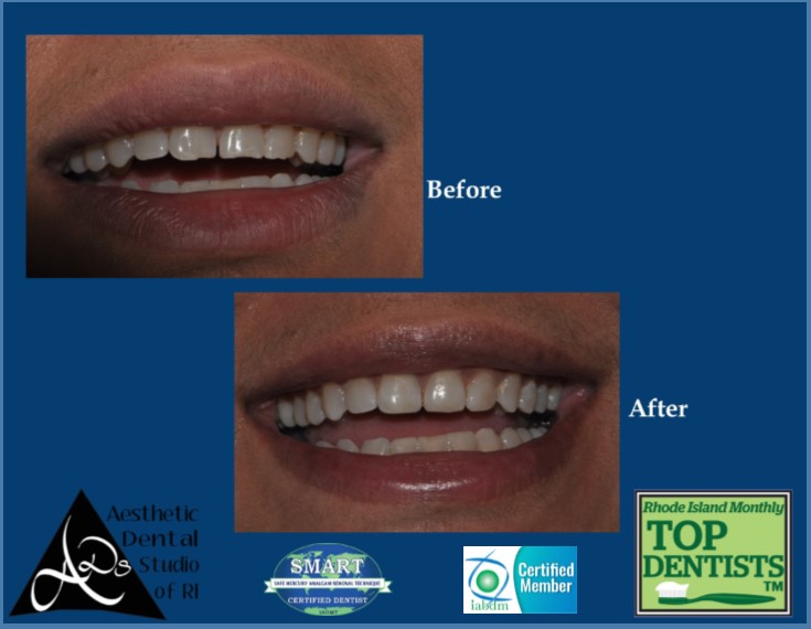 adsri_smile's tweet image. Do you have a tooth that needs help?  This is max, It has been  7 years since he SAID...LET&apos;S DO IT!!!  Are you ready 401-232-7777, call now we can help you :)
#biologicaldentistry #amalgamsafe #SMARTprotocol #ozonedentaltherapy #lovemysmile #toxicteeth