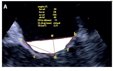 Sul #GIC una interessante rassegna sull’iter diagnostico-terapeutico del paziente con insufficienza mitralica ischemica con un approccio critico sistematico alla luce delle conoscenze attuali. By Carpenito et al. con la guida di Grigioni
 #echofirst
giornaledicardiologia.it/archivio/3766/…