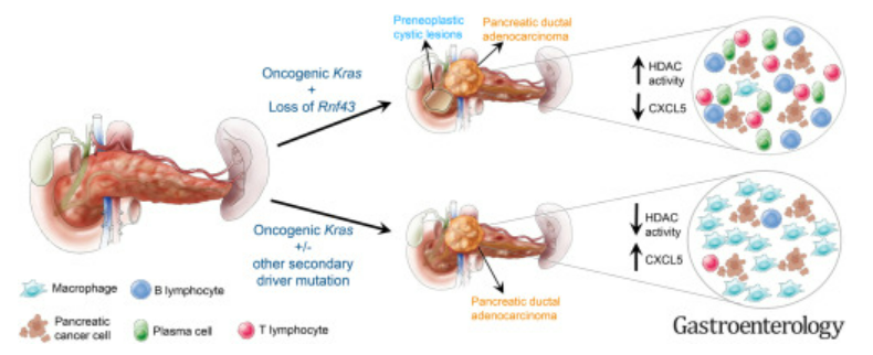 Douglas Corley (@douglascorley) on Twitter photo New insights into Kras-mediated pancreatic adenocarcinoma, including remodeling of the tumor immune microenvironment
gastrojournal.org/article/S0016-…
<a href="/UmaMahadevanIBD/">Uma Mahadevan</a> <a href="/IBDMD/">David T. Rubin, MD</a> <a href="/RickPeekMD/">Rick Peek</a> <a href="/Aiims1742/">Anirban Maitra</a> New insights into Kras-mediated pancreatic adenocarcinoma, including remodeling of the tumor immune microenvironment
gastrojournal.org/article/S0016-…
<a href="/UmaMahadevanIBD/">Uma Mahadevan</a> <a href="/IBDMD/">David T. Rubin, MD</a> <a href="/RickPeekMD/">Rick Peek</a> <a href="/Aiims1742/">Anirban Maitra</a>