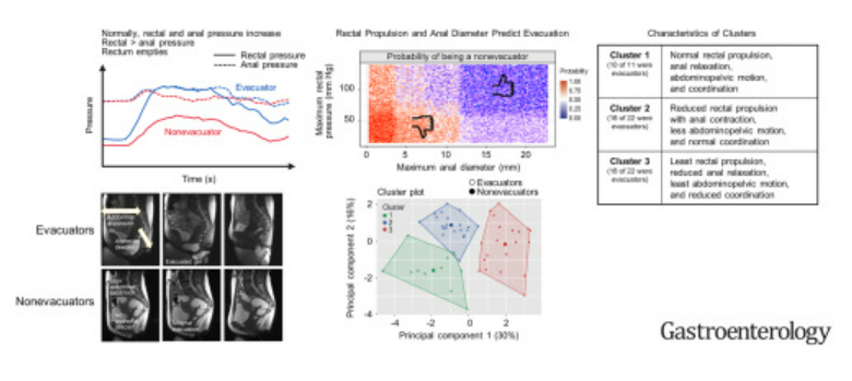 Douglas Corley (@douglascorley) on Twitter photo New insights, a difficult problem: rectal pressure, relaxation. and abdominopelvic coordination and defecatory disorders
gastrojournal.org/article/S0016-…
<a href="/UmaMahadevanIBD/">Uma Mahadevan</a> <a href="/IBDMD/">David T. Rubin, MD</a> <a href="/RickPeekMD/">Rick Peek</a> <a href="/AmerGastroAssn/">American Gastroenterological Association (AGA)</a> <a href="/MayoClinicGIHep/">Mayo Clinic Gastroenterology & Hepatology</a> <a href="/ANMSociety/">ANMS</a> <a href="/IFFGD/">IFFGD</a> <a href="/BrototoD/">Brototo Deb (Brodie), MD, MIDS</a> <a href="/drmikesh/">Mayank Sharma</a> <a href="/EdwardLoftus2/">Edward Loftus</a> <a href="/IrisWangMD/">Xiao Jing (Iris) Wang, M.D.</a> New insights, a difficult problem: rectal pressure, relaxation. and abdominopelvic coordination and defecatory disorders
gastrojournal.org/article/S0016-…
<a href="/UmaMahadevanIBD/">Uma Mahadevan</a> <a href="/IBDMD/">David T. Rubin, MD</a> <a href="/RickPeekMD/">Rick Peek</a> <a href="/AmerGastroAssn/">American Gastroenterological Association (AGA)</a> <a href="/MayoClinicGIHep/">Mayo Clinic Gastroenterology & Hepatology</a> <a href="/ANMSociety/">ANMS</a> <a href="/IFFGD/">IFFGD</a> <a href="/BrototoD/">Brototo Deb (Brodie), MD, MIDS</a> <a href="/drmikesh/">Mayank Sharma</a> <a href="/EdwardLoftus2/">Edward Loftus</a> <a href="/IrisWangMD/">Xiao Jing (Iris) Wang, M.D.</a>