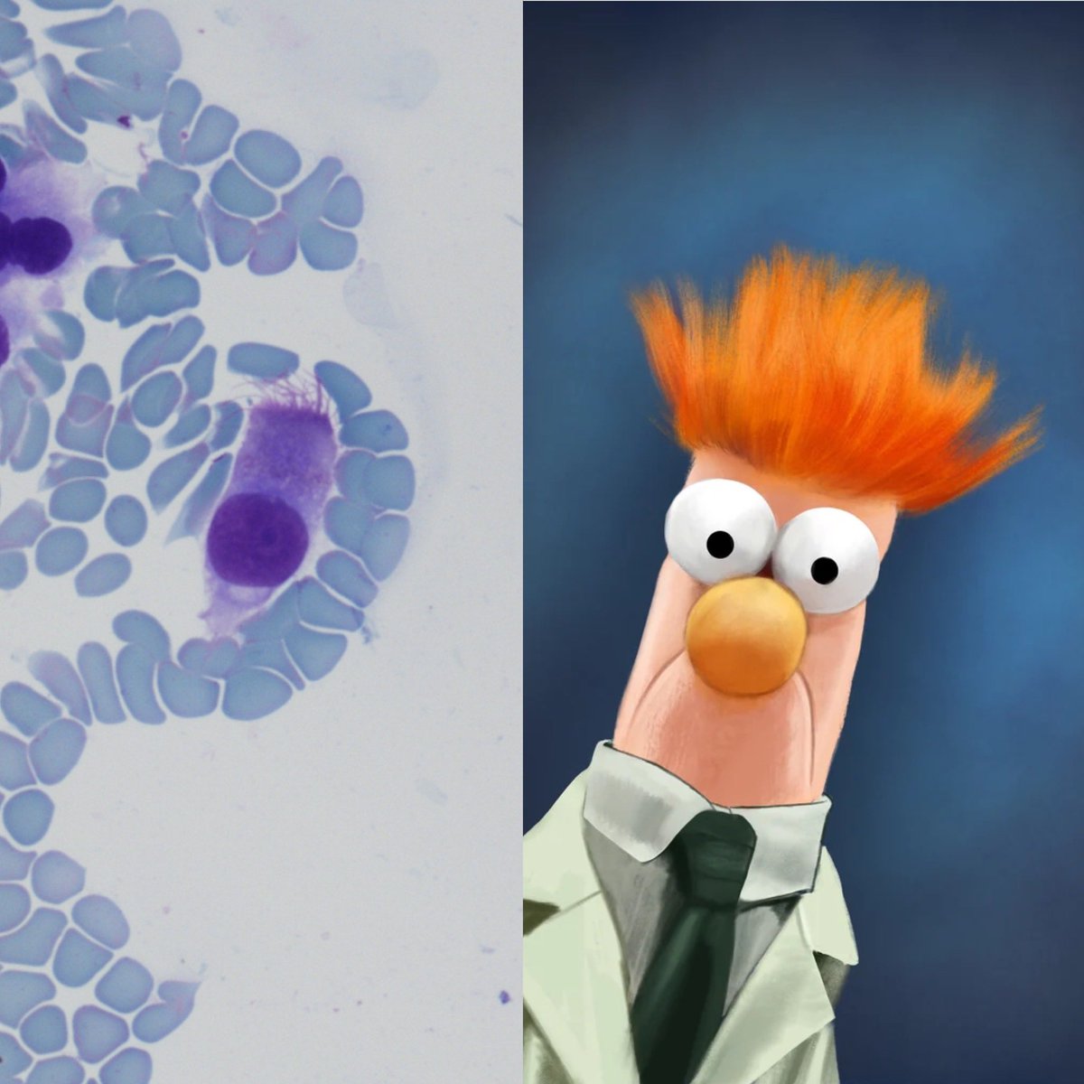 No matter how many cute little ciliated respiratory cells I see, all I can see and think of is Beaker from the Muppets. “Meep!” Sorry I’m not sorry 🤷🏼‍♂️ 🔬
#CytoPath #PathTwitter #Benign #Cilia