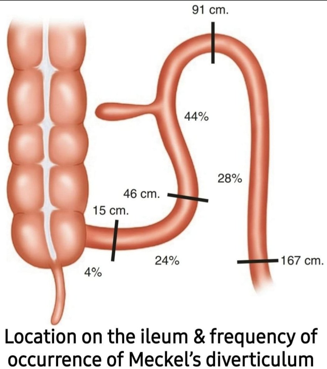 Meckel Process Meckel Diverticulum