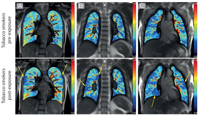 MRI shows promise as a noninvasive way to assess the short-term effects of vaping and tobacco smoking -- effects that manifest in different ways on medical images, says a new study in <a href="/radiology_rsna/">Radiology</a>. #radiology #MRI  bit.ly/37pGYiP