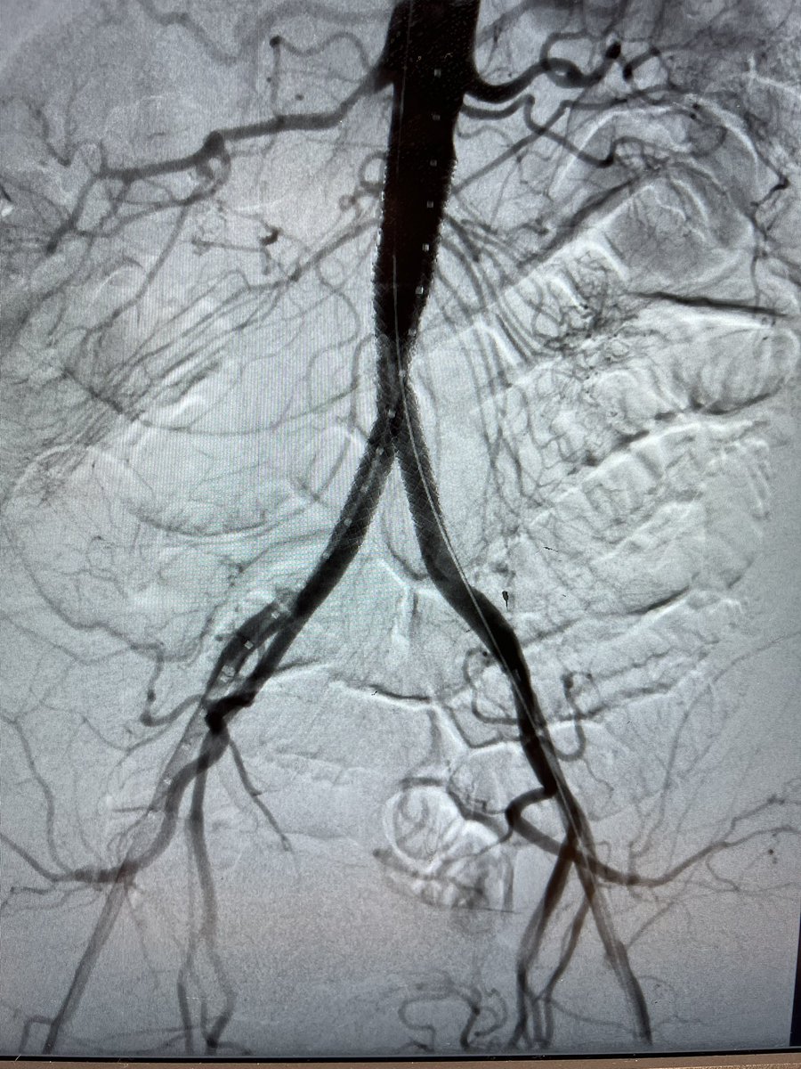 University of Colorado VIR (@ircolorado) on Twitter photo Aortoiliac occlusive disease with significant claudication s/p CERAB technique with 11mm VBX at aorta (post dilated to 16mm proximally and 14 distally) and 8mm kissing VBX with our very own <a href="/GZlotchenko/">George Zlotchenko MD</a> <a href="/pj_rochon/">PJ Rochon</a> <a href="/LWalkerMD/">Lisa Walker</a>
<a href="/CURadiology/">CU Radiology</a> <a href="/SIRspecialists/">Society of Interventional Radiology</a> <a href="/SIR_ECS/">SIR ECS</a> Aortoiliac occlusive disease with significant claudication s/p CERAB technique with 11mm VBX at aorta (post dilated to 16mm proximally and 14 distally) and 8mm kissing VBX with our very own <a href="/GZlotchenko/">George Zlotchenko MD</a> <a href="/pj_rochon/">PJ Rochon</a> <a href="/LWalkerMD/">Lisa Walker</a>
<a href="/CURadiology/">CU Radiology</a> <a href="/SIRspecialists/">Society of Interventional Radiology</a> <a href="/SIR_ECS/">SIR ECS</a>