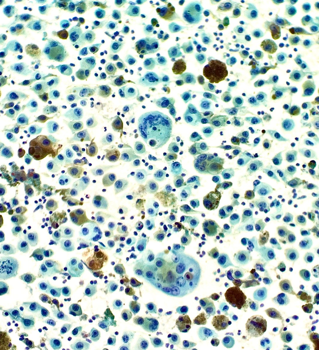 Gloria_SuraMD's tweet photo. Fine needle aspiration of a lymph node containing metastatic melanoma. Pigmented, pleomorphic tumor cells are seen on Papanicolaou stain. #PathTwitter #Pathology #CytoPath #Melanoma https://t.co/tLzkvLy6ve