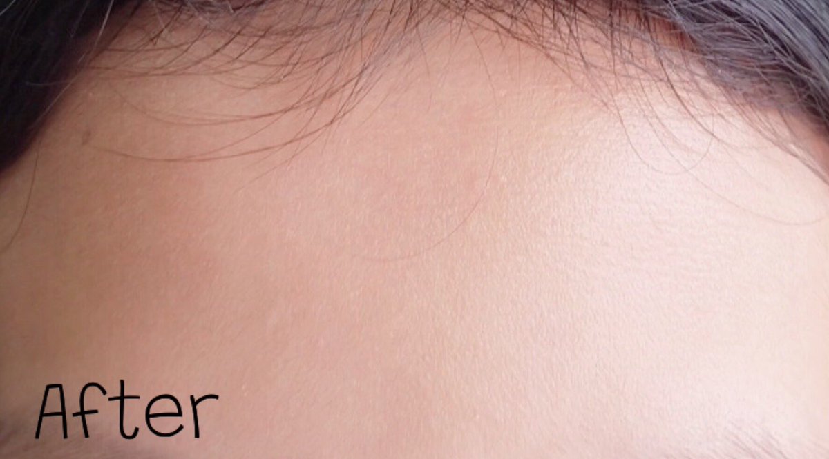 9nine0625's tweet photo. เห็นคนเขียนบล็อกรีวิวตัวนี้เยอะเลยลองใช้ดูบ้าง Tween Hab-5 เป็นเจลบำรุงลดสิว✨ ใช้มาระยะนึงแล้วรู้สึกผิวที่หน้าผากดีขึ้น จากปกติที่จะมีสิวผดเยอะและไม่เรียบเนียน ตัวนี้ผิวแพ้ง่ายใช้ได้นะ ไม่มีส่วนผสมของน้ำมัน แอลกอฮอล์ น้ำหอม ซิลิโคน และพาราเบน

#Clearacne #Hab5 #BL11 #รักษาสิว https://t.co/Fh1dPidqhW