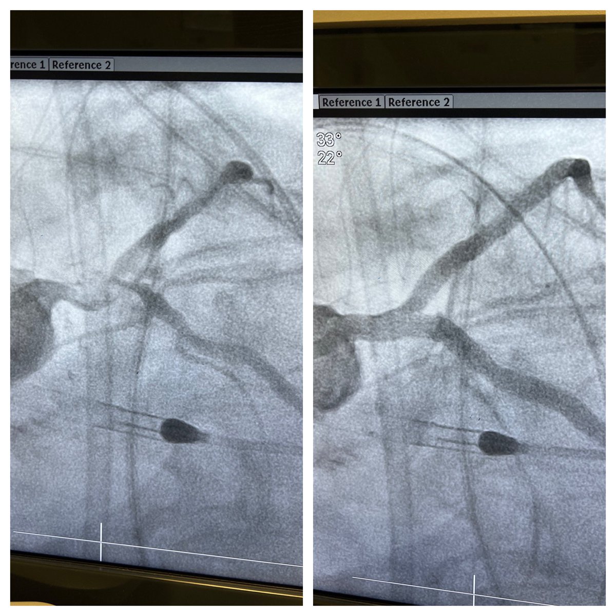 Surgical turndown. Impella supported rota-shock. DK crush.