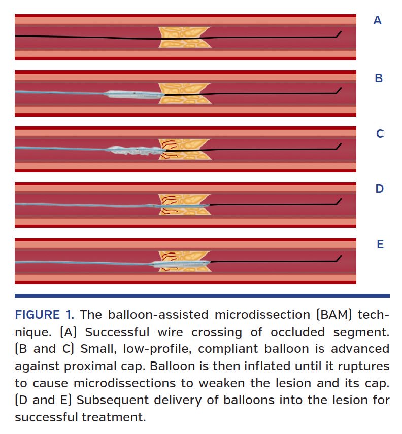 Instead of angioplasty, CTO operators can do "grenadoplasty," which is intentional balloon rupture with a small 1.25/1.5 balloon to cause balloon-assisted microdissection, modifying the plaque, leading to successful cross with another balloon. #Advanced #SoCool #Radialfirst #CTO