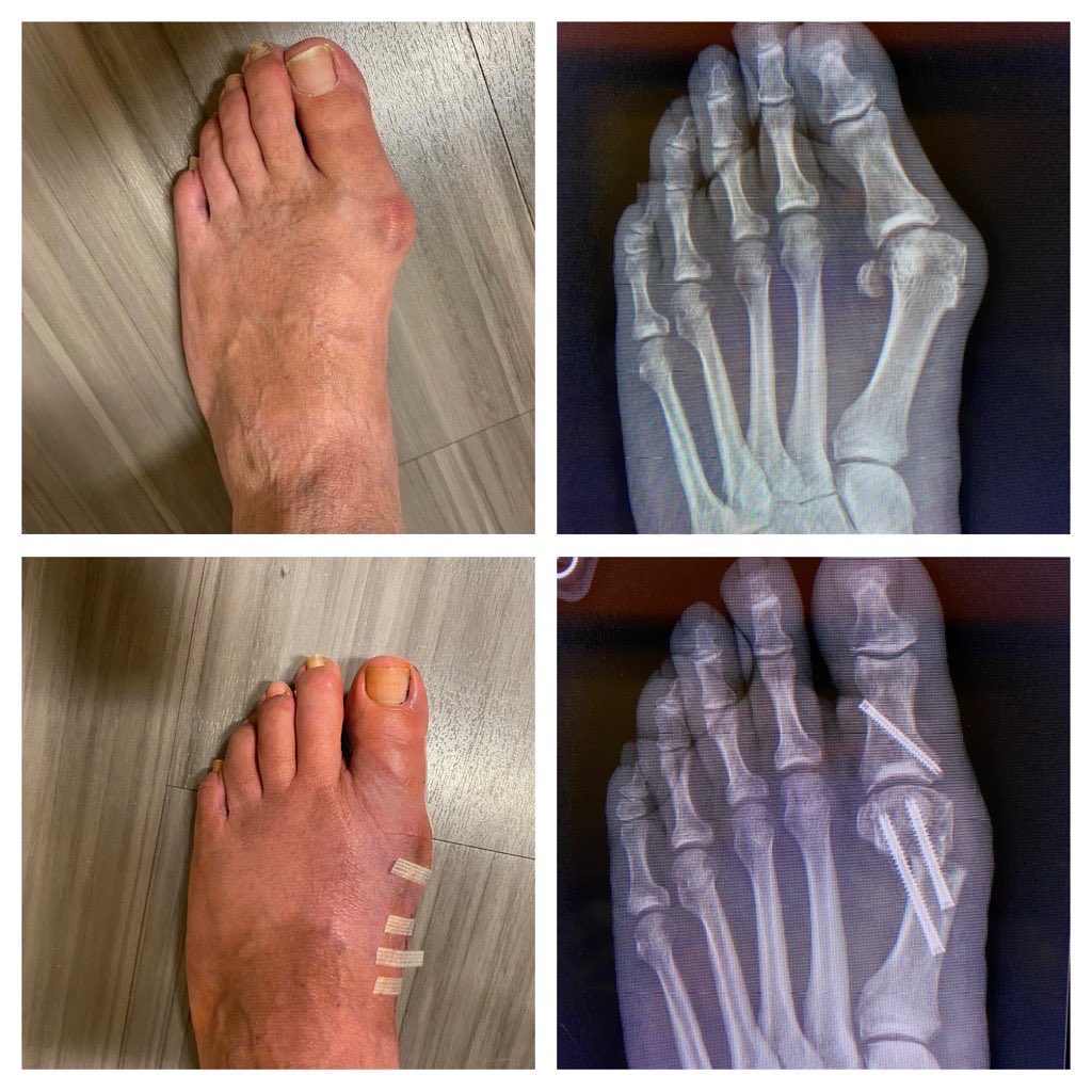 NathanGauseMD's tweet photo. Minimally invasive bunion correction 
Smaller incisions. Less pain. Joint sparing. 
#orthotwitter https://t.co/OX6BaHaCYP