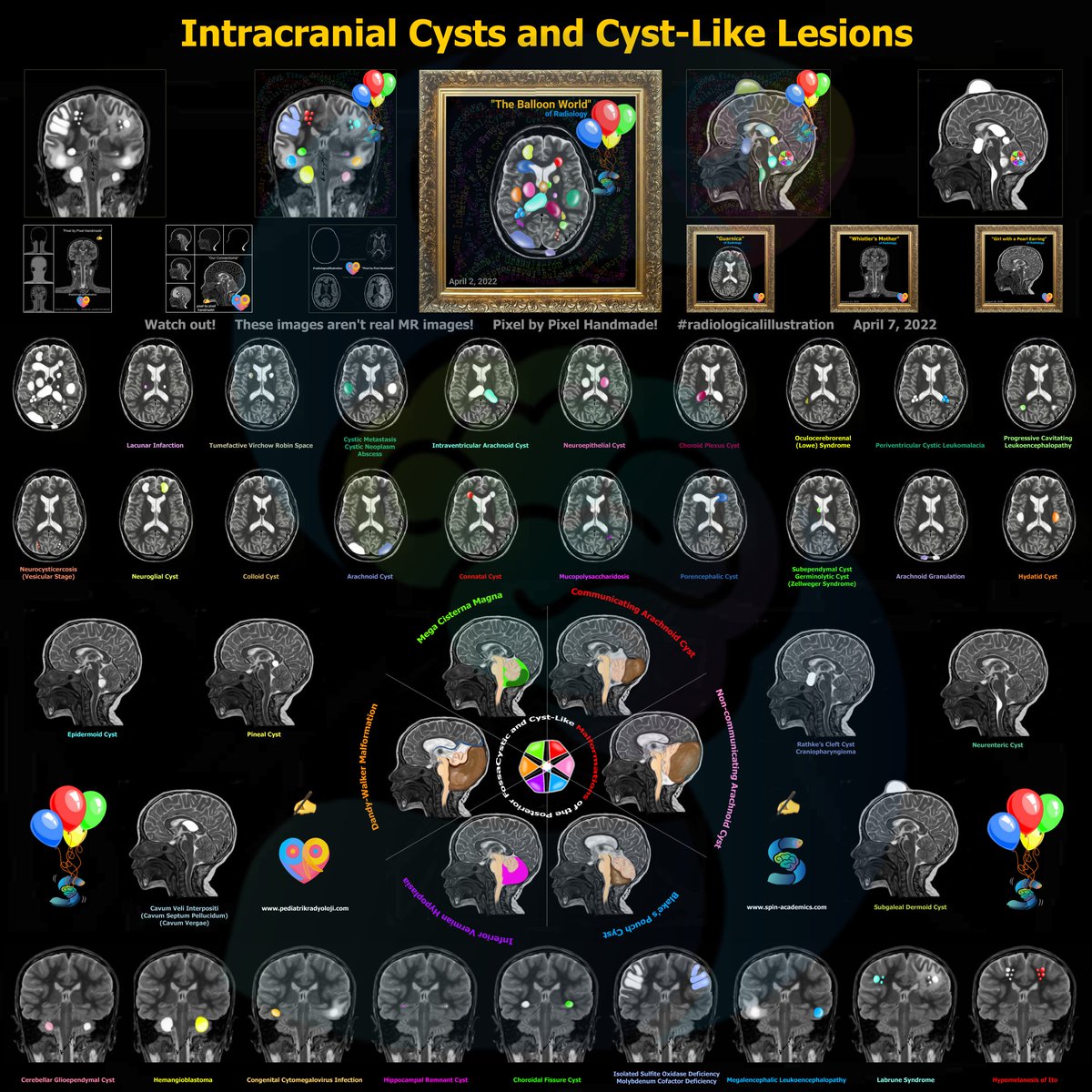 drharunyildiz's tweet photo. Intracranial Cysts and Cyst-Like Lesions 

Another wallpaper for #MedTwitter 😇 

#radiologicalillustration ✍️
@nihaal08 @RyanBPetersonMD @WmOBrienDO @MohitAgNeurorad @JudyGadde @tabby_kennedy @cookyscan1 @StefanTigges @francizdeng @drSurjthVattoth @samrad77 @mossabas @drmankad https://t.co/R8qJYiuZkd