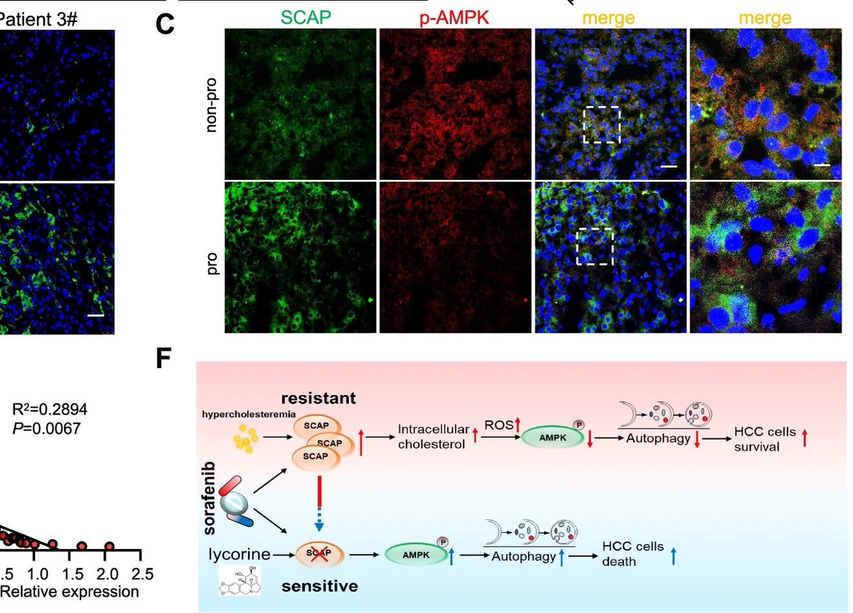 JournalofExper1's tweet photo. Just published! 🎯
#Cholesterol sensor #SCAP contributes to sorafenib resistance by regulating #autophagy in #hepatocellularcarcinoma
Read here ⏬🧐
https://t.co/AsmmwWqx9H
#SorafenibResistant
#Lycorine
@IREISGufficiale https://t.co/tV0Mqu1pak