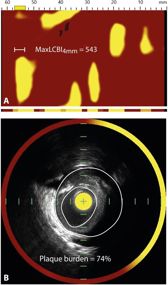 RCMjournal's tweet photo. #RCM - Vol. 23 No. 1
🩸Review
Identification and treatment of the vulnerable coronary plaque

#VulnerablePlaque #Atherosclerosis #AcuteCoronarySyndrome #IntracoronaryImaging
#Non_invasive_imaging
@NielsvdSangen @BimmerClaessen 

Fulltext:
https://t.co/cfcPtWRbYo https://t.co/laR9acMC30