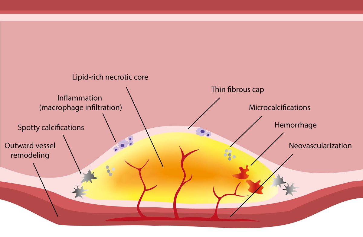RCMjournal's tweet photo. #RCM - Vol. 23 No. 1
🩸Review
Identification and treatment of the vulnerable coronary plaque

#VulnerablePlaque #Atherosclerosis #AcuteCoronarySyndrome #IntracoronaryImaging
#Non_invasive_imaging
@NielsvdSangen @BimmerClaessen 

Fulltext:
https://t.co/cfcPtWRbYo https://t.co/laR9acMC30