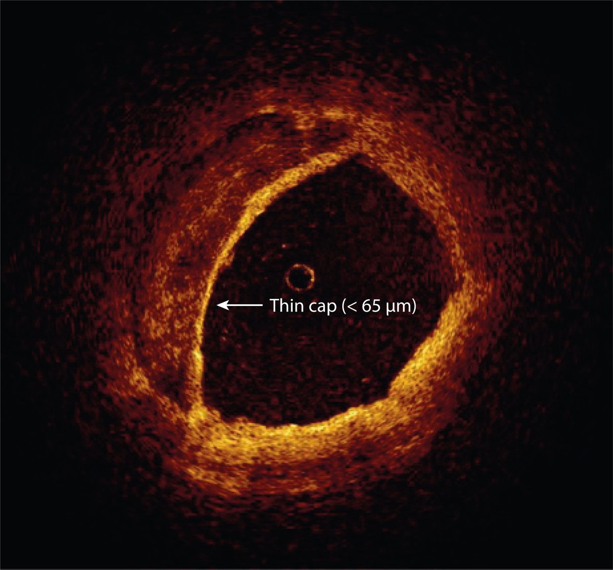 Reviews in Cardiovascular Medicine (@rcmjournal) on Twitter photo #RCM - Vol. 23 No. 1
🩸Review
Identification and treatment of the vulnerable coronary plaque
#VulnerablePlaque #Atherosclerosis #AcuteCoronarySyndrome #IntracoronaryImaging
#Non_invasive_imaging
<a href="/NielsvdSangen/">Niels van der Sangen</a> <a href="/BimmerClaessen/">Bimmer Claessen</a>
Fulltext:
imrpress.com/journal/RCM/23… #RCM - Vol. 23 No. 1
🩸Review
Identification and treatment of the vulnerable coronary plaque
#VulnerablePlaque #Atherosclerosis #AcuteCoronarySyndrome #IntracoronaryImaging
#Non_invasive_imaging
<a href="/NielsvdSangen/">Niels van der Sangen</a> <a href="/BimmerClaessen/">Bimmer Claessen</a>
Fulltext:
imrpress.com/journal/RCM/23…