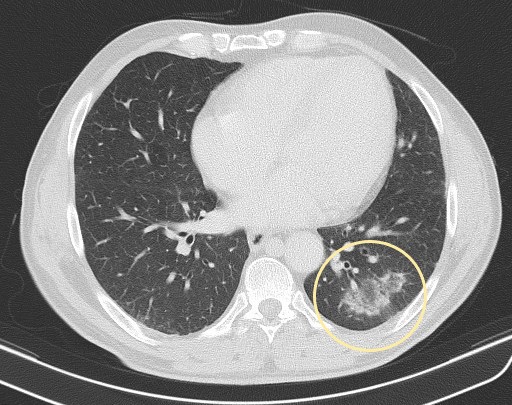 joaomabrantes's tweet photo. Reversed halo sign and the importance of clinical data and ancillary radiological data. As our patient recently started chemotherapy we can narrow our ddx to secondary OP or atypical manifestation of pulmonary metastatic disease - Source article: https://t.co/A0MwrG3q8J https://t.co/GSKZwLIh91