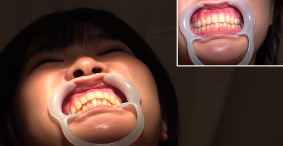 teeth_fetch's tweet photo. 歯科治��フェチにはたまらない、立派なインレーの入った女の子の治療動画。

欲を言えばインレーを嵌めているところが見たかったのですが、CR充填でも良しとしよう

女の子可愛いのでおすすめです！
→https://t.co/kUSqObbOUz

#口内フェチ #口腔フェチ #歯フェチ #銀歯フェチ #歯科治療 #舌フェチ https://t.co/iNxpcwetLt
