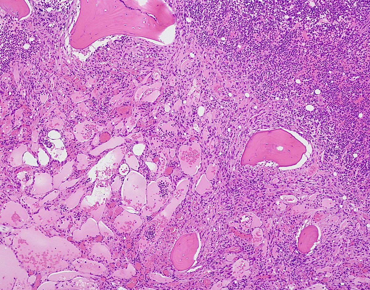 Gloria_SuraMD's tweet photo. Bone marrow biopsy of a patient with untreated HIV revealing involvement by Kaposi sarcoma. Spindled tumor cells are seen forming irregular, dilated vascular spaces. HHV-8 immunostain was positive in tumor cells. #PathTwitter #PathArt #Pathology #BSTPath https://t.co/5T51EE3bxM
