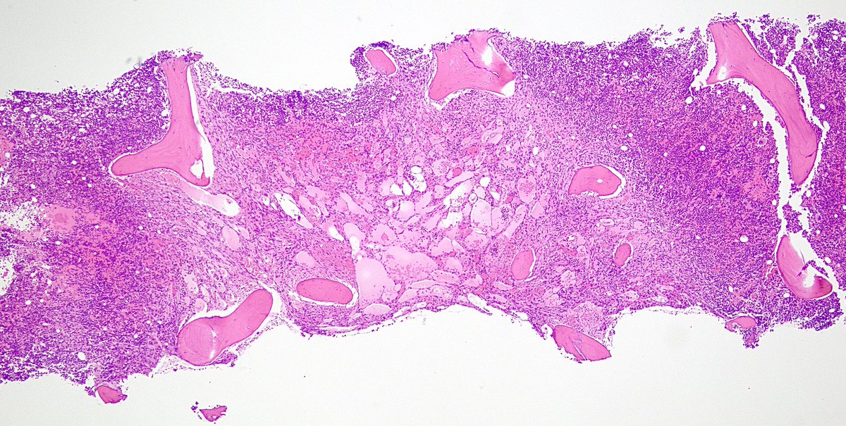 Gloria_SuraMD's tweet photo. Bone marrow biopsy of a patient with untreated HIV revealing involvement by Kaposi sarcoma. Spindled tumor cells are seen forming irregular, dilated vascular spaces. HHV-8 immunostain was positive in tumor cells. #PathTwitter #PathArt #Pathology #BSTPath https://t.co/5T51EE3bxM