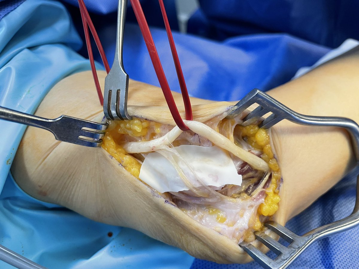 Pacomartinezmtn's tweet photo. Transposición submuscular nervio cubital. Indicado en rectificas o patología traumática previa de codo!!  Submuscular transposition of the ulnar nerve.  Indicated in rectifications or previous traumatic pathology of the elbow!! @SecmaSociedad @AAOS1 @sechc_oficial @secotsecot https://t.co/0KUOXoNAOh