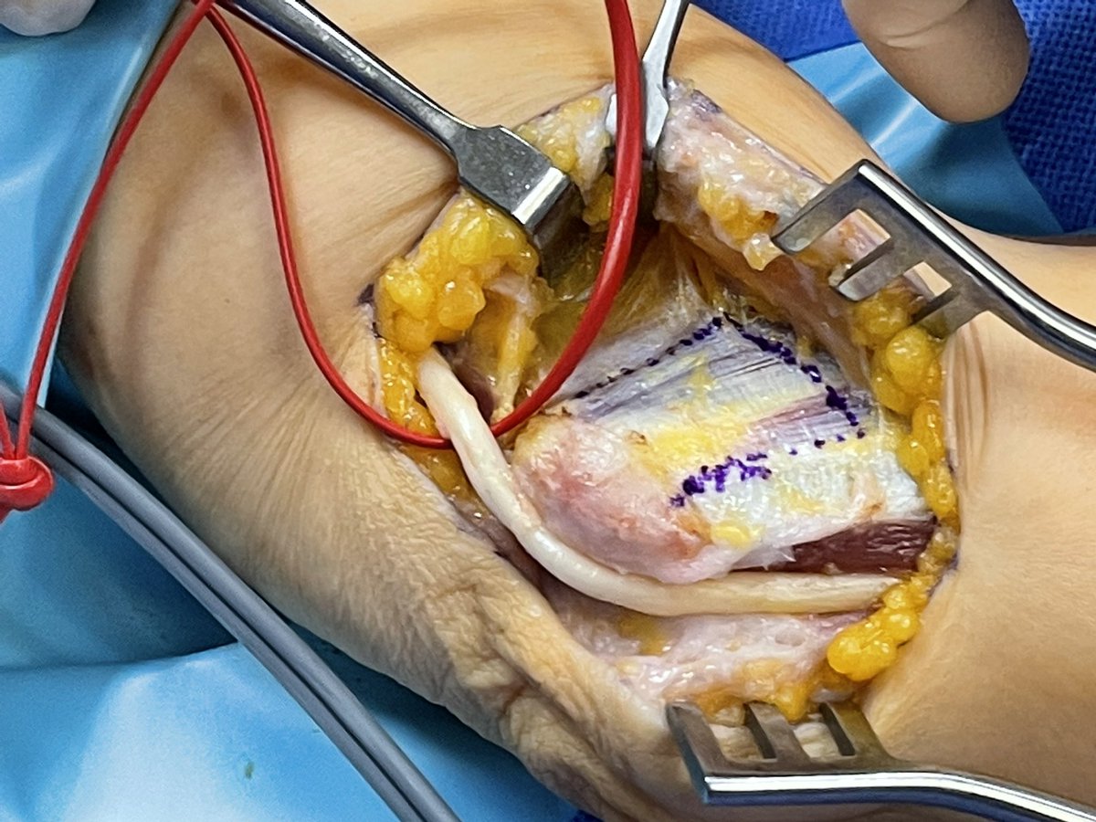 Pacomartinezmtn's tweet photo. Transposición submuscular nervio cubital. Indicado en rectificas o patología traumática previa de codo!!  Submuscular transposition of the ulnar nerve.  Indicated in rectifications or previous traumatic pathology of the elbow!! @SecmaSociedad @AAOS1 @sechc_oficial @secotsecot https://t.co/0KUOXoNAOh