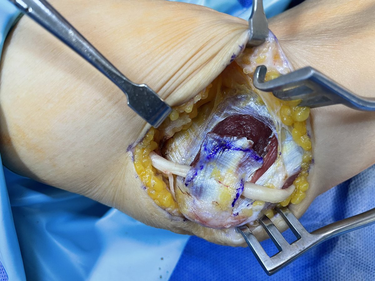 Transposición submuscular nervio cubital. Indicado en rectificas o patología traumática previa de codo!!  Submuscular transposition of the ulnar nerve.  Indicated in rectifications or previous traumatic pathology of the elbow!! <a href="/SecmaSociedad/">SECMA</a> <a href="/AAOS1/">AAOS</a> <a href="/sechc_oficial/">SECHC</a> <a href="/secotsecot/">@secotsecot</a>