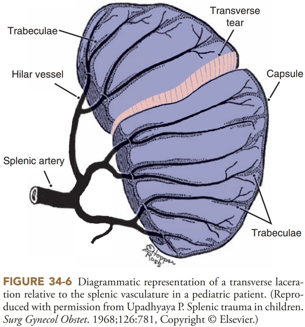 DRAFTABAHMED7's tweet photo. Transverse laceration of spleen in pediatric patients:
𝗥𝗲𝗳:Trauma 9th ed.
#MedTwitter #Trauma
#Bluntabdominaltrauma
#damagecontrolsurgery 
#splenicinjury https://t.co/tsLw5vQkZS
