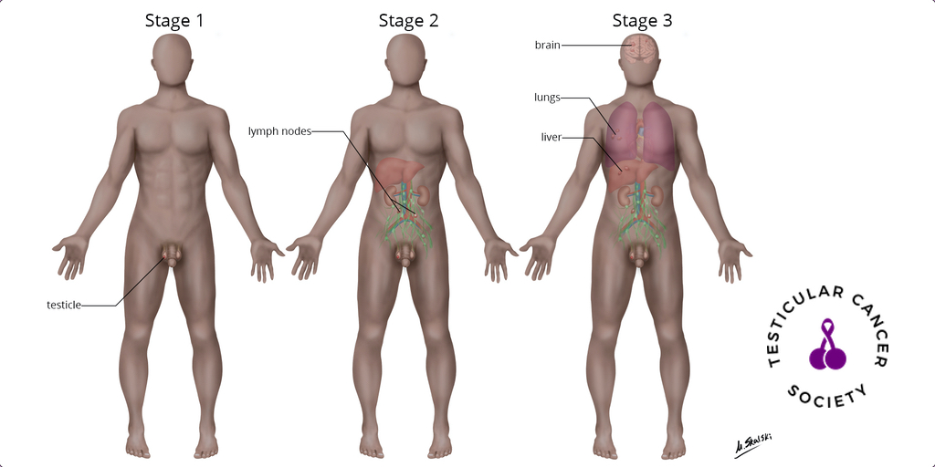 Early detection of #TesticularCancer is key.

Stage 1: Cancer is confined to the testicle(s)

Stage 2: Cancer has spread into the abdomen

Stage 3: Cancer has spread to the lungs, liver, brain or bone

Reduce the Burden of Treatments by Catching it Early. #TCisNoJoke