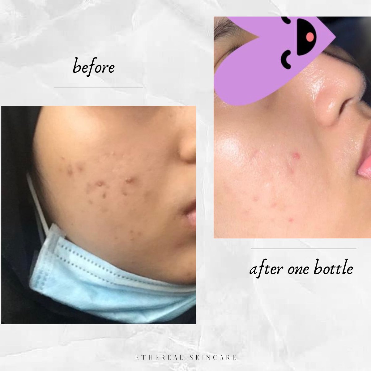 Pastel_HQ's tweet photo. Look at how amazing Absolute Serum. The acne scars and dark spots are fading after only one bottle! 🕊 https://t.co/2ScXlLQz7h