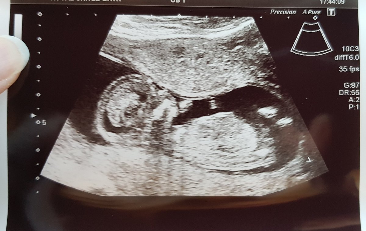 Very excited to say my husband and I are expecting a baby! This term has been so tough - contending with morning sickness, exhaustion, grumpiness etc on top of 2nd rounds of Y11 and Y13 mocks and moving house... safe to say I'm looking forward to the Easter break! #14weeks