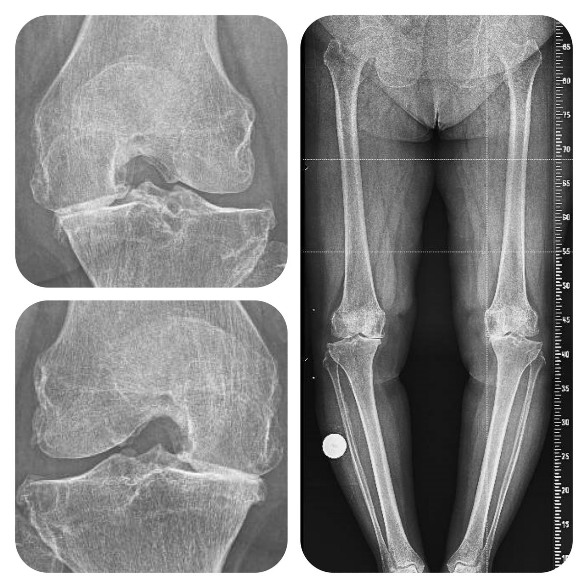 doctorgelber's tweet photo. 64yo 👵 invalidating bilateral knee pain
✈️ to BCN: IC harvesting🩸 
21 days 🧪🧫 
✈️ to BCN: stem cells infiltration 

12,000€ for 3️⃣0️⃣ days pain relief 
🫵STOP CHEATING ON PEOPLE 🫵 https://t.co/Bhz6gYY7Sg