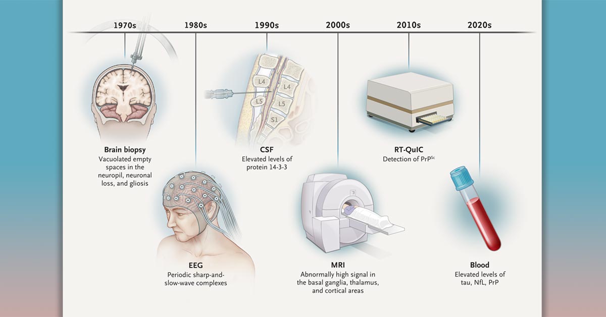 NEJM on Twitter "New review article covers CreutzfeldtJakob disease