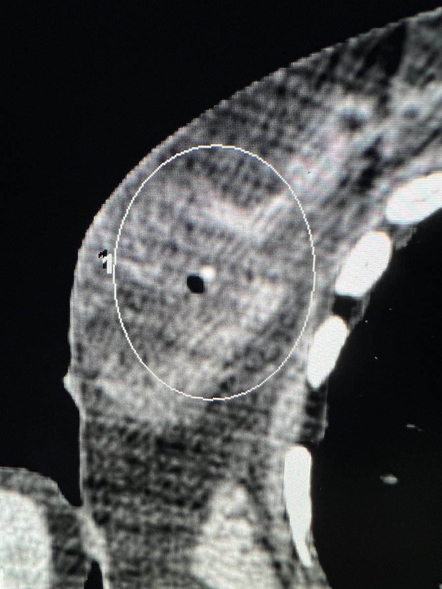 Fighting #breastcancer  <a href="/NYGH_News/">North York General</a>! Neoadjuvant Rx, residual IDC + clip. Developed severe neuropathy precluding Sx. Tumor board said #Cryoablation Ice Pearl 2.1, protective hydrodissection. Posted w permission ⁦@CARadiologists⁩ <a href="/CAIRweb/">Canadian Association for Interventional Radiology</a> <a href="/UofTMedIm/">UofT Medical Imaging</a> thx <a href="/DrPatKennedy/">Patrick Kennedy</a> assist
