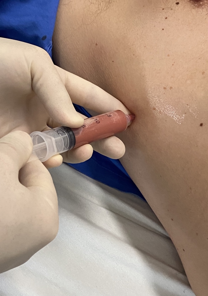 umanamd's tweet image. Not good…
#thoracentesis
#EMprocedures