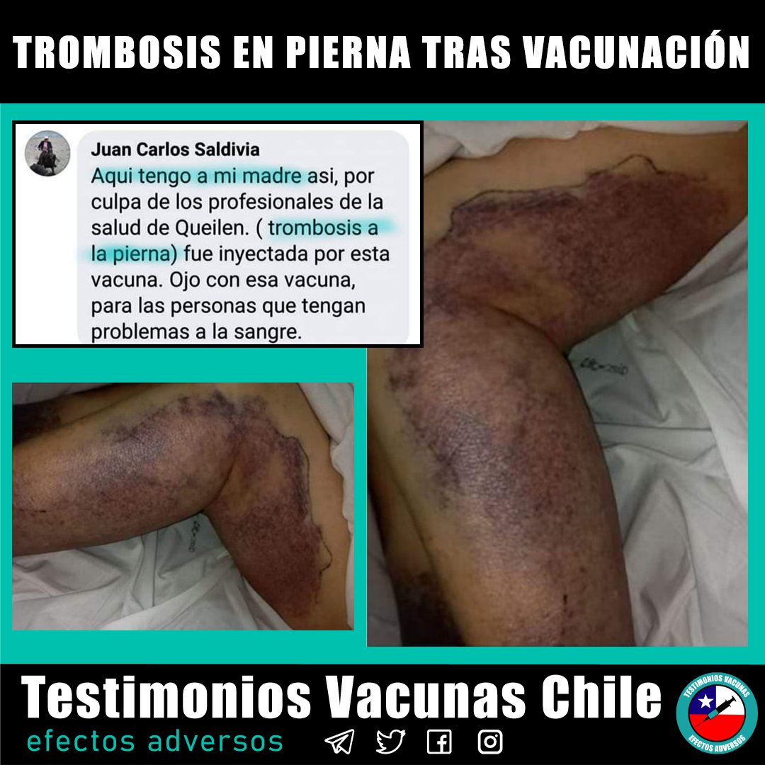 tvc_chile's tweet photo. 🛑 Testimonio Juan Carlos : " Tengo a mi madre así (..) Trombosis a la pierna por esta vacuna  " 

https://t.co/vFH2OoxbjN

#ChaoPase #NoAlPaseDeMovilidad #DictaduraSanitaria https://t.co/8olXZhLy4X