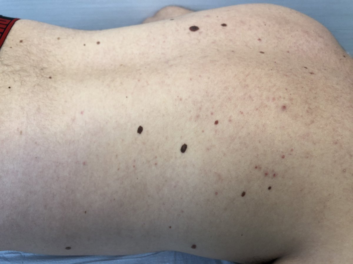 20 años Síndrome del nevus displásico 3 años sin venir a controles  (pandemia por medio) En el control de la semana pasada presenta lesión  pigmentada con pseudópodos,retículo invertido central y \u003e3 colores, image size:1200x900