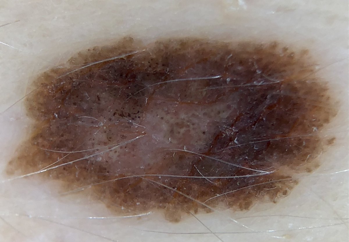 20 años Síndrome del nevus displásico 3 años sin venir a controles  (pandemia por medio) En el control de la semana pasada presenta lesión  pigmentada con pseudópodos,retículo invertido central y \u003e3 colores, image size:1200x831