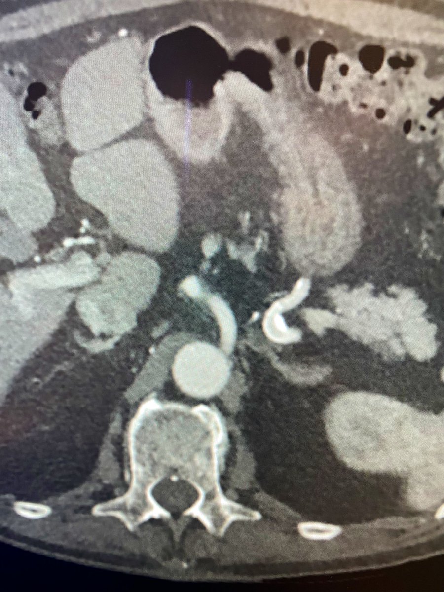 2 years status-post placement of a flow diverting stent to treat an enlarging splenic artery aneurysm. Aneurysm remains thrombosed, splenic artery patent. Great collaborative case with our neurosurgery colleagues. #IRad @SIRspecialists @SIRRFS @AlbanyIR @AMCNeurosurgery