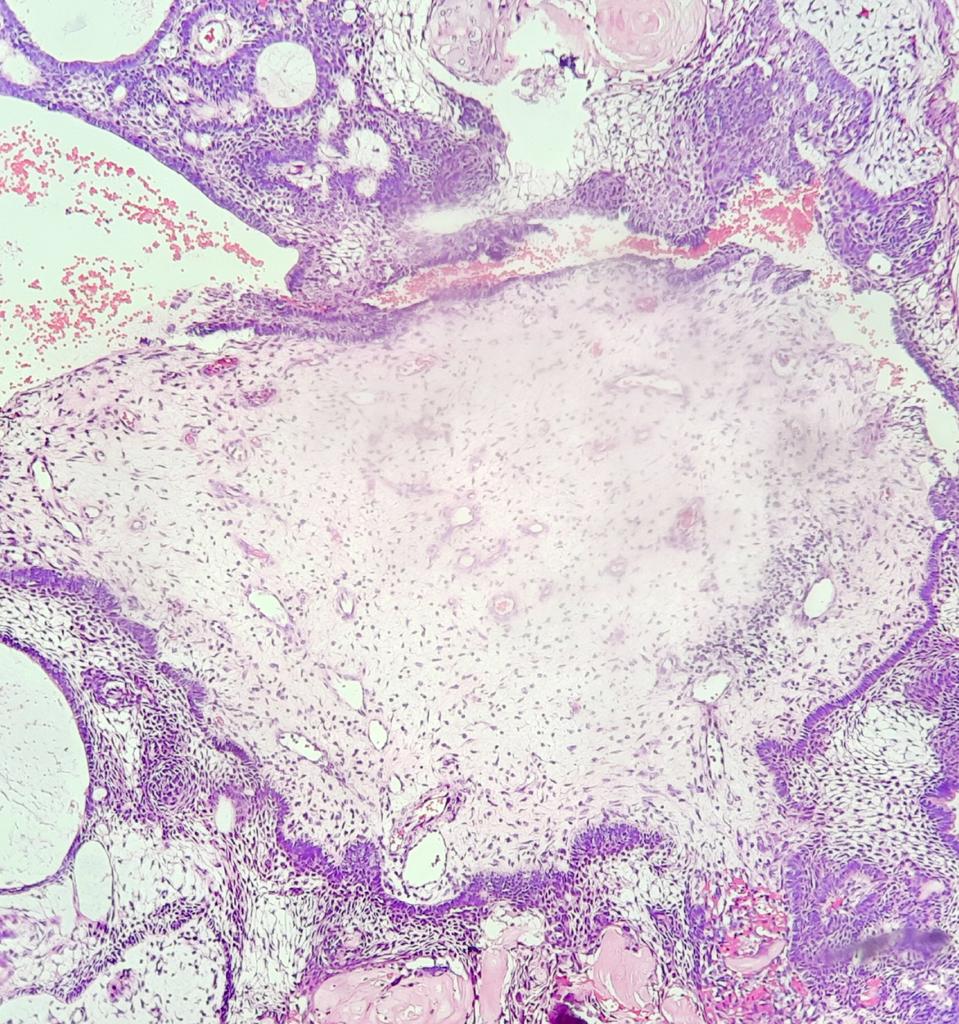pathognosis22's tweet photo. #Case3 a classic case of craniophrayngioma #PathTwitter #Histopath #pathtwitter #histology #PathArt #pathology https://t.co/pWutZ1iiex