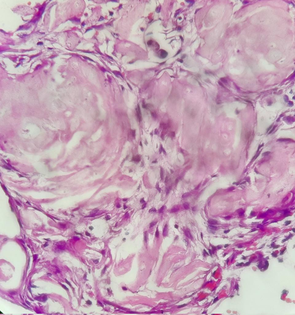 pathognosis22's tweet photo. #Case3 a classic case of craniophrayngioma #PathTwitter #Histopath #pathtwitter #histology #PathArt #pathology https://t.co/pWutZ1iiex