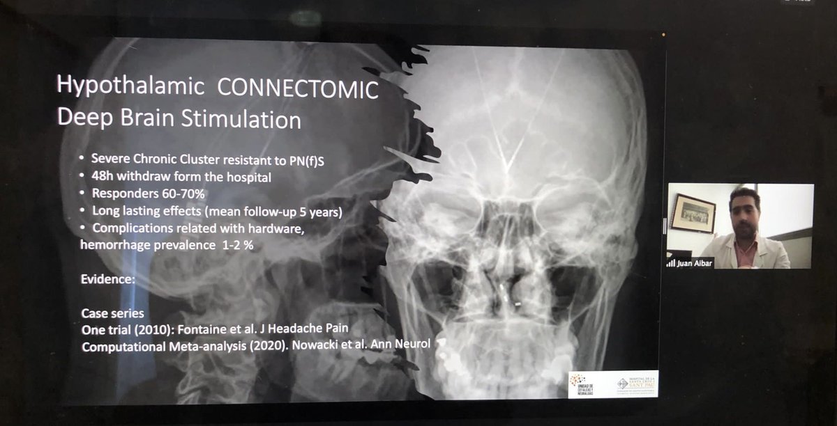 Juan_Aibar_'s tweet photo. Great experience today in the catalan meeting for headache management. Talking about advanced treatment for #cluster headache and trigeminal #neuralgia!! 
Thanks for the trust!! Great team!! @NMorolln @robertbelvis @HospitalSantPau https://t.co/EyWC9uS8a6
