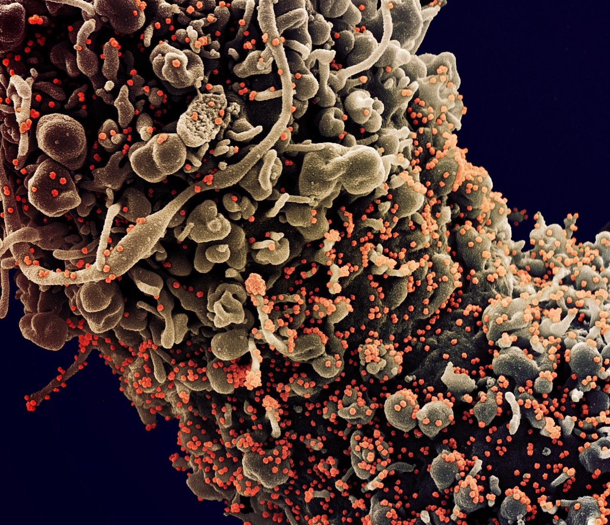 NewsMedical's tweet photo. SARS-CoV-2 detected using smartphone biosensor https://t.co/etWogKI1Jw #Coronavirus #Particle #diffusometry #isothermal #SARSCo-2 #Diagnostic #Smartphone #rapiddetection @LifeAtPurdue https://t.co/C1Ie910836