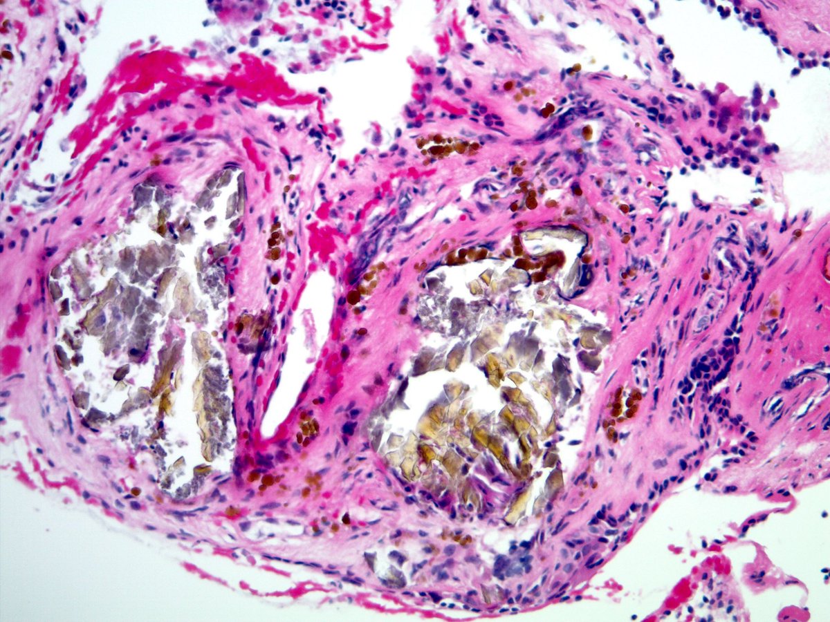 smlungpathguy's tweet photo. Can you guess the clinical story from these 3 images? https://t.co/3zP9EBHmuJ