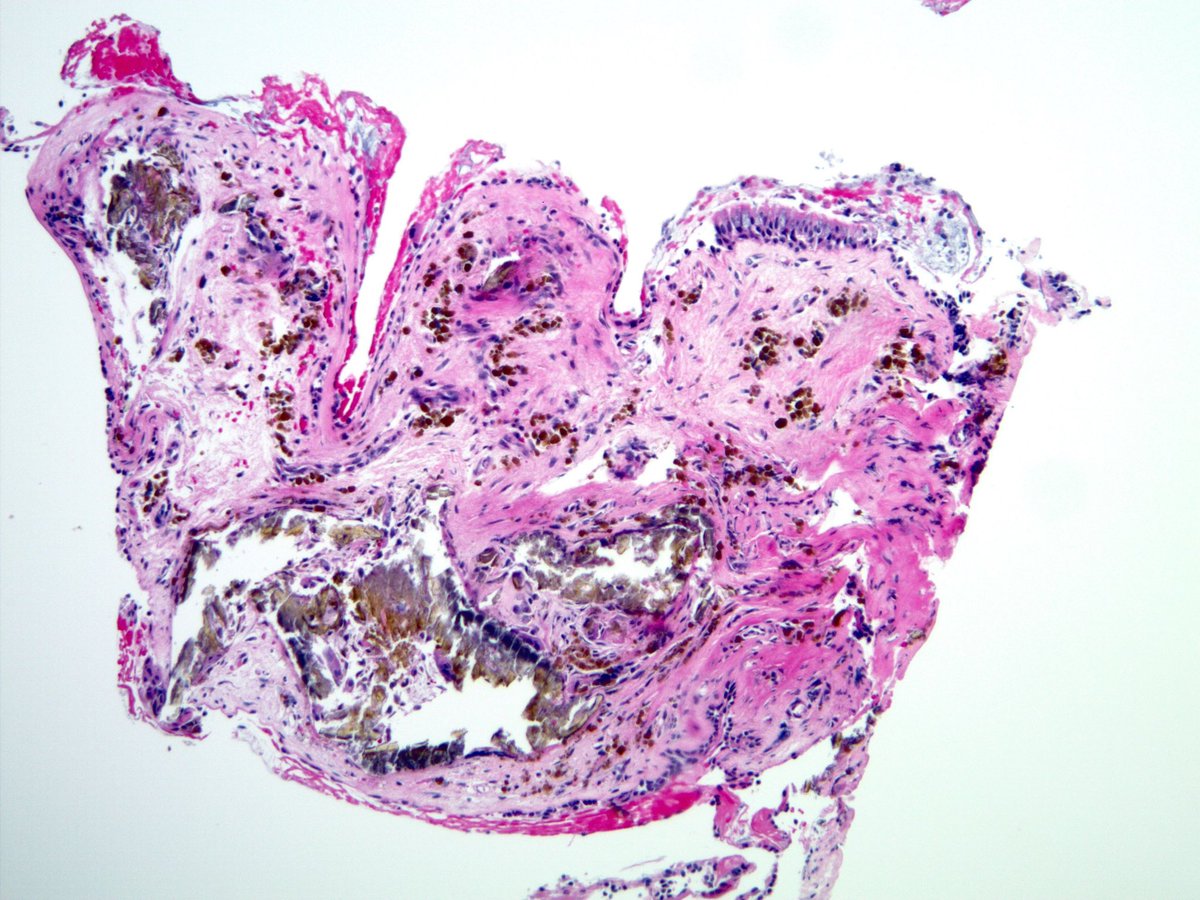smlungpathguy's tweet photo. Can you guess the clinical story from these 3 images? https://t.co/3zP9EBHmuJ